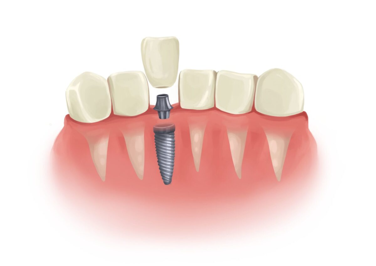 Drawing of a dental implant replacing a missing front tooth