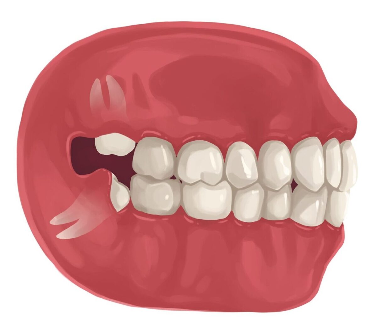 Drawing of wisdom teeth emerging, causing overcrowding