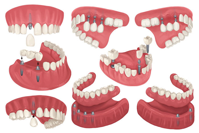 Illustrations of different configurations of dental implants to replace missing teeth