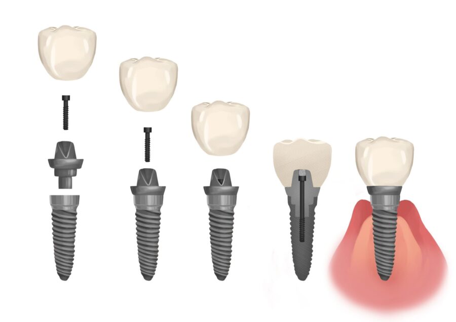 Illustration of the components of a dental implant permanent tooth replacement
