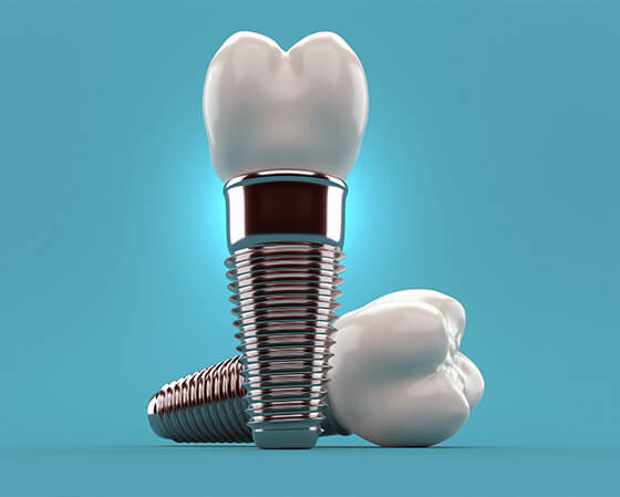 dental implants