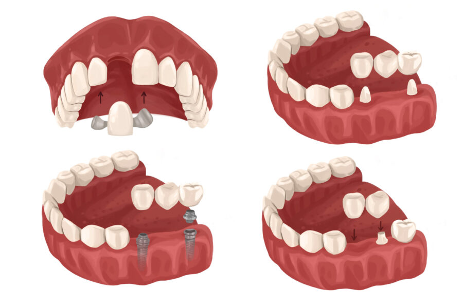 Different configurations of dental bridges to replace missing teeth