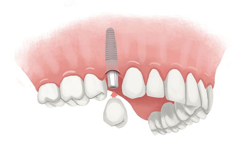 Illustration of a dental implant replacing a missing tooth in an upper jaw