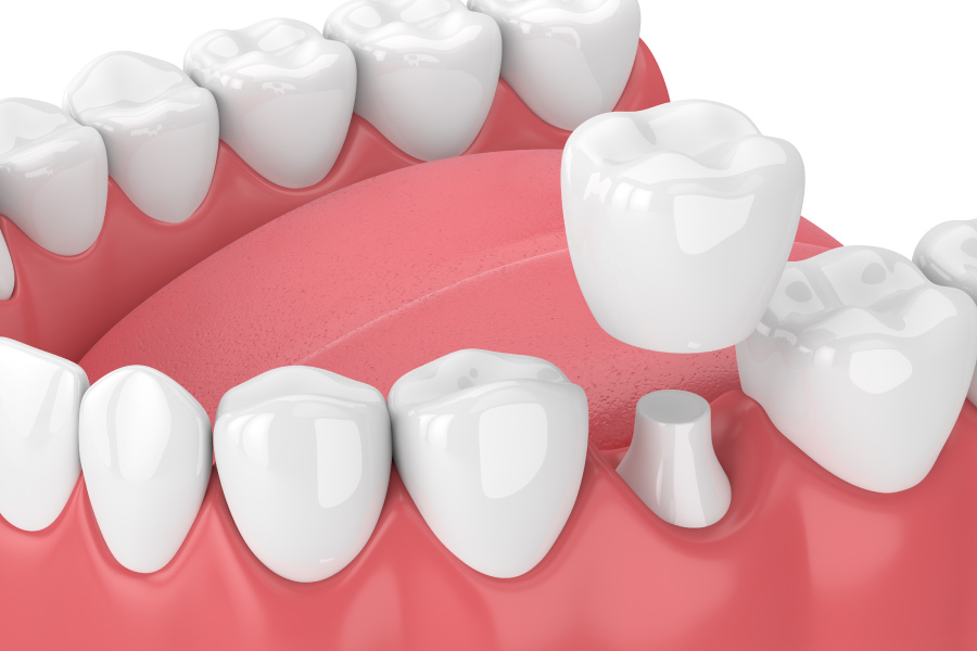 Closeup graphic of a dental crown protecting a damaged natural tooth