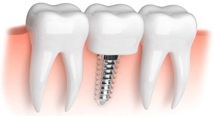 closeup of a dental implant with an artificial tooth sandwiched between 2 natural tooth roots