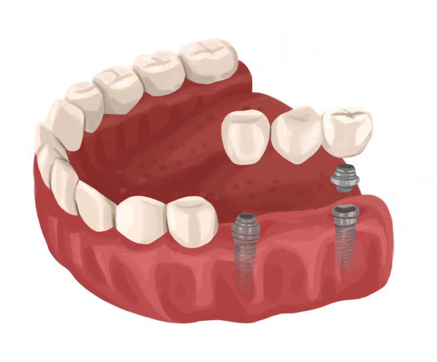 Graphic illustration of dental implant supported bridge, a type of dental implant.