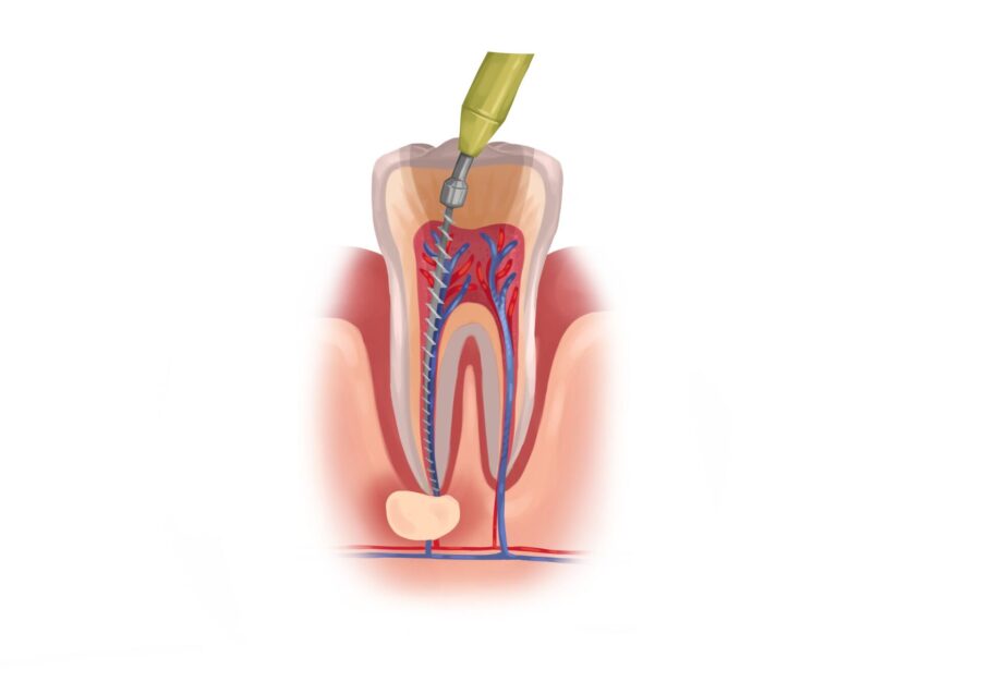 medically accurate graphic illustration of root canal therapy, root canal treatment